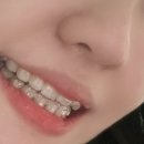 이가편한미치과의원 | [치아교정일기] 6. 인비절라인 10일차, 첫 장치 후기 - 강동구 둔촌동치과, 연세꿈꾸는치과
