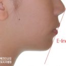 에스플란트치과병원 | 중학생 청소년 치아교정_치아 맹출장애 크라우딩, 사랑니 발치교정 후기