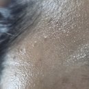 엄마손한의원 | 부산편평사마귀제거한의원 부산쥐젖제거한의원 서면편평사마귀제거-1탄 병원선택