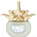 척추관 협착증(spinal stenosis) 이미지