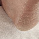 경산 하양 발각질 제거로 뽀송뽀송한 발 재은네일뷰티 닥터아이티엔