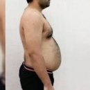 복부 대동맥류 증상 허리통증 복부팽만감 원인 이미지