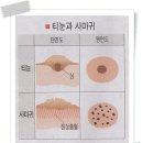 티문 이미지