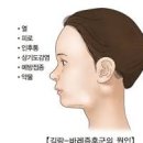 길랑 바레 증후군 길랭 바레 증후군 원인 방법 종류 위급상황 이미지