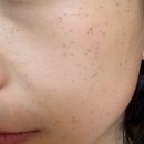 유어라인 | 미금 유어라인의원 편평사마귀 제거후기 전후비교사진 가격