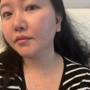 안성한의원 | 안성평택편평사마귀제거 쥐젖제거 무제한 성지 한의원에서 제거 3주차까지 후기