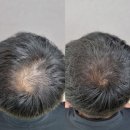 한올SMP | 영통두피탈모관리 SMP 세종뷰티 수원영통점 남편이 다녀온 후기