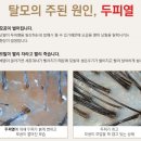 김호가발·탈모두피