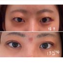 고요의원 | [공지] 강남 아몬드성형외과 자연유착+눈매교정 후기｜붓기, 멍, 가격｜이인호 원장님
