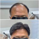 리커맨드 | 리커맨드 hair LAB 강남남성가발 정수리탈모 맞춤가발 남자가발