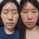 백수한의원 | ※3년 외모관리 후기 / 안면비대칭 균형 치료 경락...대한 고찰 현타 / 아름턱한의원,비대칭경락샵