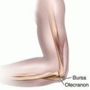 주두 점액낭염﻿[Elbow (Olecranon) bursitis] 이미지