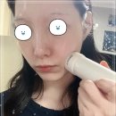 대한유지 | 리쥬란 후 유지기간 관리 후기