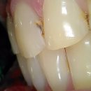 크라운 | 앞니 사이가 벌어지고 누래요. 라미네이트와 PFM 크라운 교체 후기