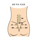 자석을 이용한 골반교정 이미지