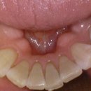 링구얼라인 이미지