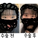 티에스 성형외과 (ㅇㅈㅍ원장님 / 소세지 눈 낮추기 6개월 후기)