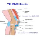 ■ 무릎 점액낭염(Bursitis)의 원인. 증상. 치료. 합병증 이미지