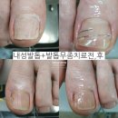 사랑의원 | 내성발톱 무좀 치료 여기 진짜 잘하네요“발톱 또 뽑을까봐 울었어요…” 부평 리솜사랑의원 다녀온 후기
