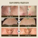 프로핏코스메틱 - 창원시 성산구 용지로265번길 4 | 요즘 에스테틱에서 염증ㅣ모공 ㅣ미백 가장 잘 잡아주는 바이오리필 acid 산 필링 , 기존 산필링제와...