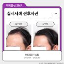 서울불광초등학교 | 은평구두피문신, 수술 없이 M자 정수리 채우는 법 (전후사진 후기有)