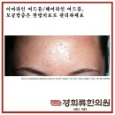 류헤어라인 이미지