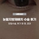 남이약국 | 내돈내산 > 30대 눈밑지방재배치 당일수술 후기 :: 상담 후기, 0~4일차 붓기 및 멍 경과, 다크서클...