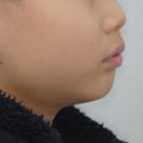 이상대치과의원 | 성남치과 더서울치과에서 초등학생 어린아이 치아교정, 인비절라인 퍼스트로 악궁 확장과 2급 부정교합...