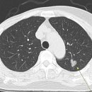 부종양 증후군[paraneoplastic neurological syndrome] 이미지