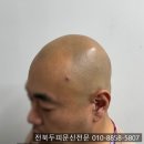 전주두피문신 SMP 가격 300만원 주고 망한후기