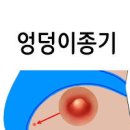 엉덩이 종기 원인 및 치료 수술 약 연고 이미지