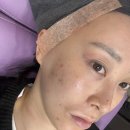 청담동 | 티타늄리프팅 부작용 청담동피부과 티타늄리프팅 후기