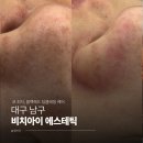 피지아이주 | [대구 남구] 대구 블랙헤드 제거 전후 비교, 단 1회만으로도 놀라운 변화 '비치아이 에스테틱' 솔직후기