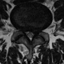 요추 4-5 large disc herniation(both side) 치료 사례 이미지