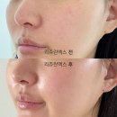 맥스샤인 - 남구 회서로 13-1 | 구월동피부과 본식관리 리쥬란 맥스 후기 (+더마샤인 통증)