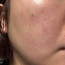 메디퍼스트 | 메디테라피 히알루론산 스킨부스터 퍼스트 세럼 후기 낋여.ㅇㅖ.