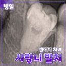 엘에이치과의원 | 서울 [매복사랑니발치] / '엘에이치과' // 중랑구 치과 충치 발치 사랑니 매복