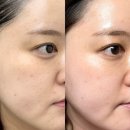 역삼역 피부과 클라리티레이저 색소 올킬 후기