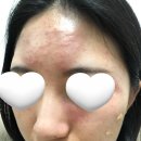 원주피부과 청담심스성형외과 여드름흉터치료 꿀조합 쥬베룩 미라젯 (내돈내산 솔직후기)