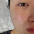 다한메디 | [수완지구피부관리] 365메디스킨 광주본점 광주여드름, 좁쌀여드름, 요철 신부관리 3일후 솔직후기