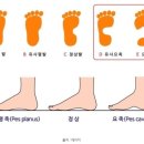 맨발 걷기 운동을 해서는 안 되는 사람 ​ 이미지