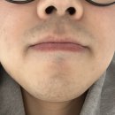 두번째 갈림길(feat. 인중 레이저제모 후기)