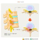 허리디스크 때문에 받았던 치료중 효과적인 치료들 후기 이미지