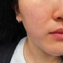 수미 피부샵 | 홍조 폭발 민감성 피부 SOS 경산 하양 엄경혜 에스테틱 1:1 맞춤 홍조관리 솔직 후기