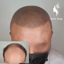 더 젊어졌단 말, 들어보셨나요?" – 두피문신으로 인생 리셋한 리얼후기 (일산 대화동 새로이숲)