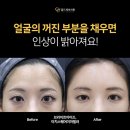 마이스터(MEISTER) | 선릉역 이마필러 부작용 울퉁불퉁 돌고래 이마 피하는 방법