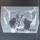 코가나이비인후과의원 | 안산 고잔동 굿이비인후과 하비갑개절제술 코유착제거수술 후기