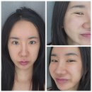 광천통앞 - 우 | 쥬베룩볼륨 석회화·유착 치료, 트라이덤 고주파 2회차 솔직 후기 (3일차 경과)