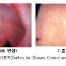 홍역 의심환자는 반드시 격리해야 하나요? 이미지