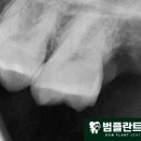 범플란트치과의원 네이버블로그